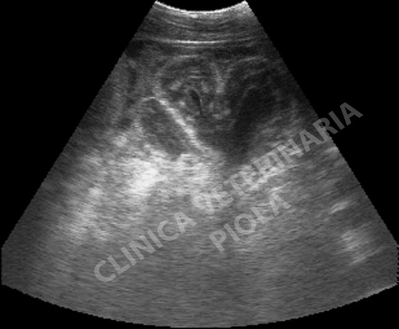 cieco edematoso per torsione